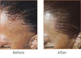 Hair Transplant before and after 4