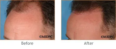 Hair Transplant before and after 6